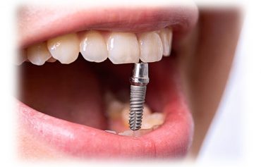 Имплантирование зубов